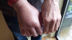 I don't understand it.  I got stung 25 times when transferring bees into Bee Beard and didn't swell up as much as this time with only 5 stings!